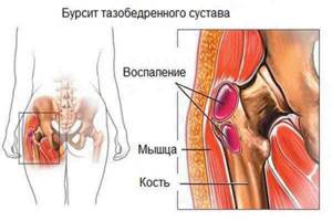 Жидкость в тазобедренном суставе - подробности о болезнях суставов на Diet4Health.ru