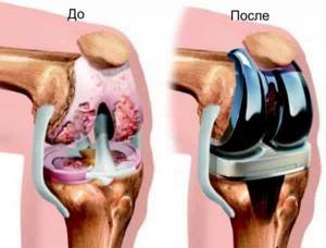 Лечение двустороннего гонартроза коленного сустава: 1, 2 и 3 степени - подробности о болезнях суставов на Diet4Health.ru