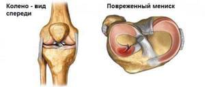Лечение деформирующего гонартроза коленного сустава 1, 2 и 3 степени - подробности о болезнях суставов на Diet4Health.ru