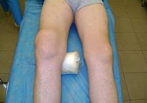 Синовиальная жидкость в коленном суставе: причины возникновения и способы лечения - подробности о болезнях суставов на Diet4Health.ru