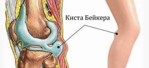 Подколенный бурсит или бурсит подколенной мышцы - подробности о болезнях суставов на Diet4Health.ru