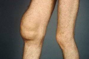 Симптомы и лечение гемартроза коленного сустава - подробности о болезнях суставов на Diet4Health.ru