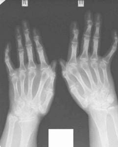 Лечение ДОА лучезапястного сустава 1 и 2 степени, а также мелких суставов кистей рук - подробности о болезнях суставов на Diet4Health.ru
