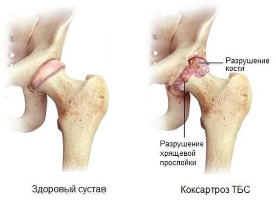 Тренировка на велотренажере при лечении артроза колена и тазобедренного сустава - подробности о болезнях суставов на Diet4Health.ru