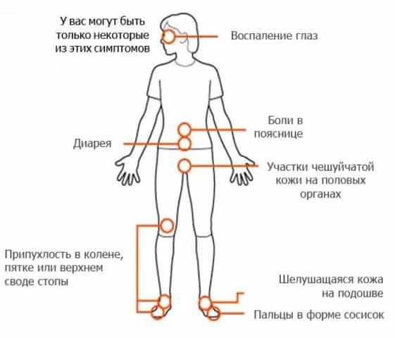 Артрит и артроз в чем разница. Артрит и артроз в чем разница лечение. Артрит и артроз разница симптомы. Артрит и артроз в чем разница профилактика и лечение.