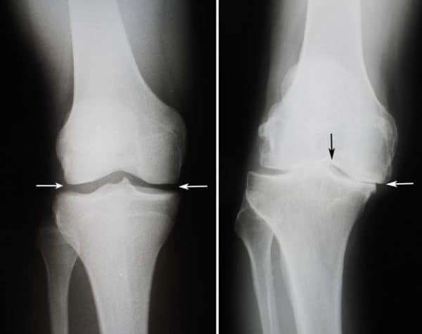 Тренировка на велотренажере при лечении артроза колена и тазобедренного сустава - подробности о болезнях суставов на Diet4Health.ru
