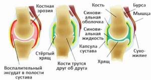 Артрит и артроз – в чём разница? - подробности о болезнях суставов на Diet4Health.ru Артрит и артроз – в чём разница? - подробности о болезнях суставов на Diet4Health.ru