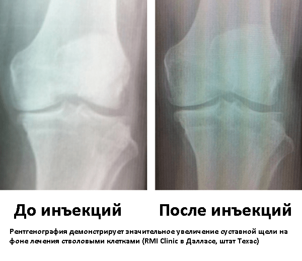 Клеточная терапия при артрозе набирает популярность в США - подробности о болезнях суставов на Diet4Health.ru