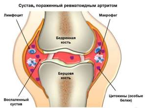 Передается ли ревматоидный артрит по наследству? - подробности о болезнях суставов на Diet4Health.ru