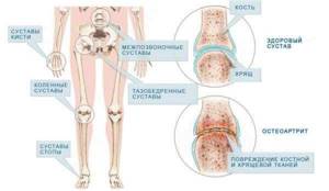 Тендинит тазобедренного сустава: симптомы, лечение и можно ли делать растяжку - подробности о болезнях суставов на Diet4Health.ru