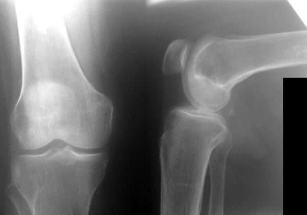 Анкилоз коленного сустава: проявления и методы лечения - подробности о болезнях суставов на Diet4Health.ru