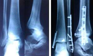 Что такое артродез голеностопного сустава? Реабилитация после операции - подробности о болезнях суставов на Diet4Health.ru