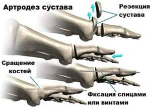 Что такое артродез голеностопного сустава? Реабилитация после операции - подробности о болезнях суставов на Diet4Health.ru