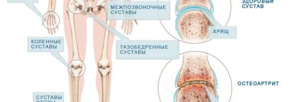 Чем отличается ревматоидный артрит от артроза? - подробности о болезнях суставов на Diet4Health.ru
