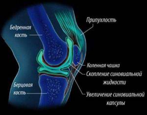 Что такое синовит коленного сустава и как его лечить - подробности о болезнях суставов на Diet4Health.ru