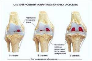 Хруст в коленном суставе - подробности о болезнях суставов на Diet4Health.ru