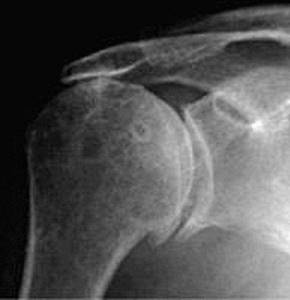 Тендинит сухожилия надостной мышцы плечевого сустава - подробности о болезнях суставов на Diet4Health.ru