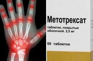 Метортрит при ревматоидном артрите - подробности о болезнях суставов на Diet4Health.ru