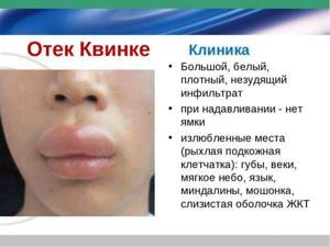 Методжект при ревматоидном артрите - подробности о болезнях суставов на Diet4Health.ru Методжект при ревматоидном артрите - подробности о болезнях суставов на Diet4Health.ru