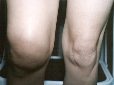 Объем жидкости в коленном суставе – прогностический фактор - подробности о болезнях суставов на Diet4Health.ru