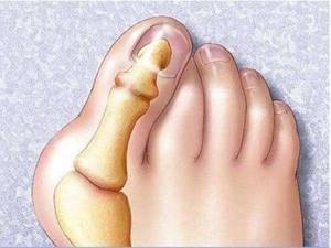 Бандаж или шина для большого пальца ноги при вальгусной деформации: обзор видов и рекомендации по выбору - подробности о болезнях суставов на Diet4Health.ru
