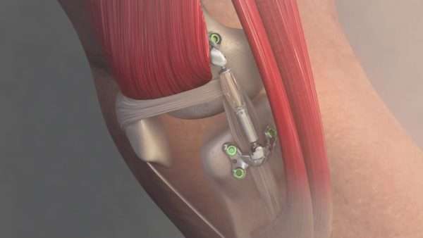 Имплантат Calypso Knee System замедляет артроз - подробности о болезнях суставов на Diet4Health.ru