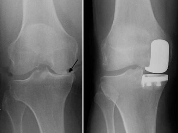 Одномыщелковое эндопротезирование коленного сустава лучше консервативного лечения - подробности о болезнях суставов на Diet4Health.ru
