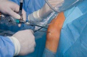 Не спешите с артроскопией — канадские хирурги - подробности о болезнях суставов на Diet4Health.ru